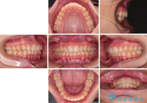 海外で始めたインビザライン 転医手続きにより治療を継続の治療後