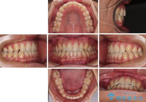 ワイヤー矯正を併用したインビザライン矯正治療の治療後