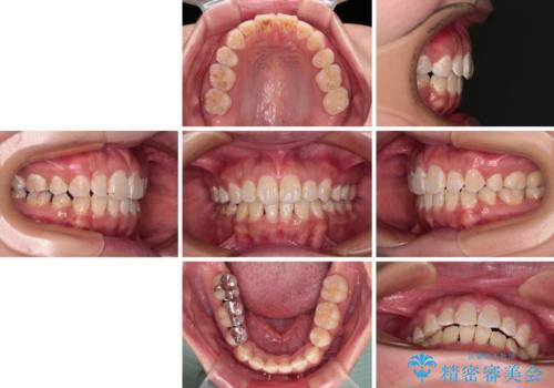 口が閉じにくい ワイヤー装置での抜歯矯正の治療後