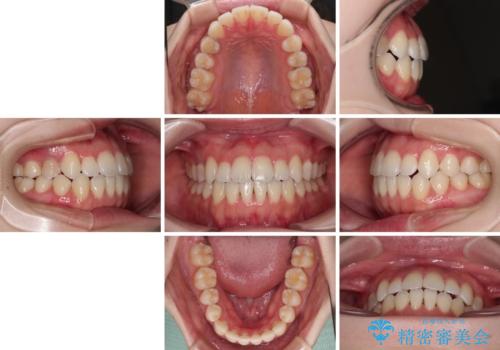 舌突出癖による開咬 舌のトレーニングを行いながら前歯の隙間を改善の治療前