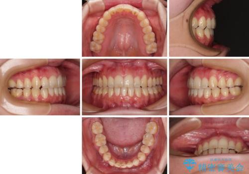 開咬と歯の欠損 ワイヤー装置を併用したインビザライン矯正治療の治療後