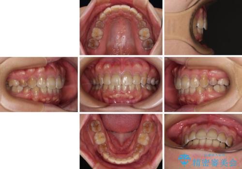 横顔の印象が大きく変わる ワイヤー装置での抜歯矯正の治療後