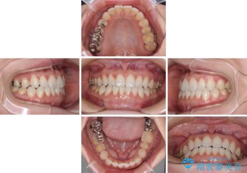 前歯のデコボコをすっきりと インビザライン矯正の治療中