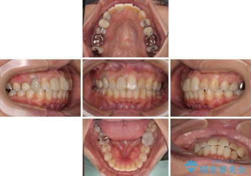【モニター】処置歯の多い歯列　インビザラインでデコボコを整えるの治療中