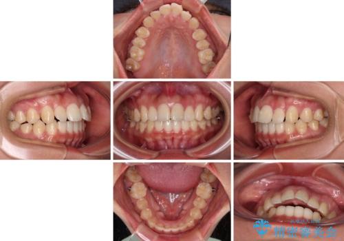 飛び出した上顎前歯 インビザラインで引っ込めるの治療中