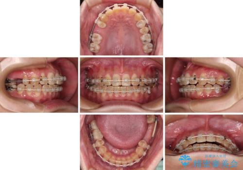 むし歯と咬み合わせで奥歯に負担がかかる　総合歯科治療で悩みを改善の治療中