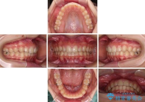 海外で始めたインビザライン 転医手続きにより治療を継続の治療中