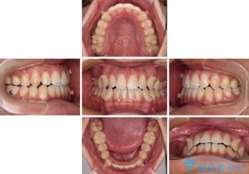 ワイヤー矯正を併用したインビザライン矯正治療の治療中