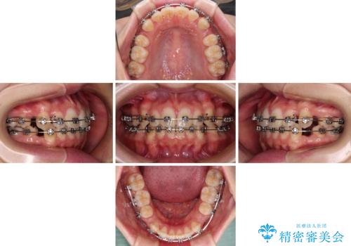 ワイヤー装置の抜歯矯正で横顔のシルエットをすっきりとの治療中