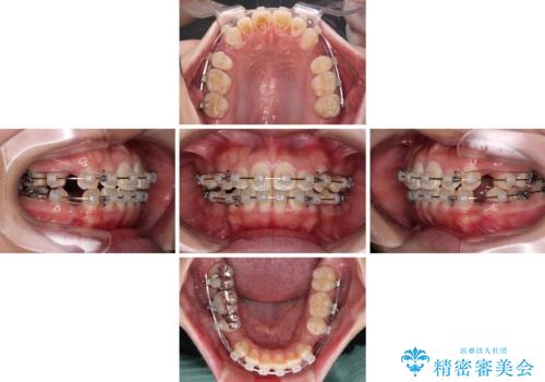 口が閉じにくい ワイヤー装置での抜歯矯正の治療中