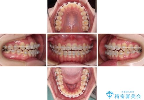 舌突出癖による開咬　舌のトレーニングを行いながら前歯の隙間を改善の治療中