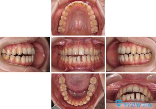 開咬と歯の欠損 ワイヤー装置を併用したインビザライン矯正治療の治療中