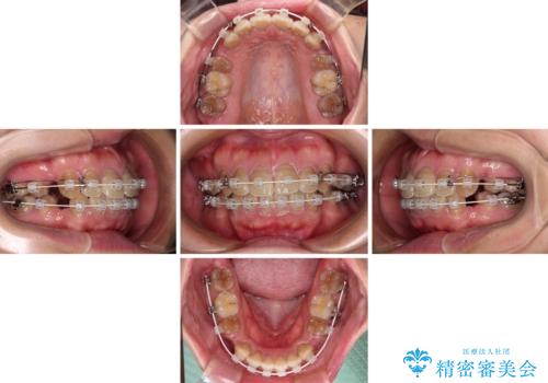横顔の印象が大きく変わる ワイヤー装置での抜歯矯正の治療中