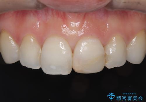 【オールセラミッククラウン】前歯の色が気になる! 左右で歯の長さが違うの症例 治療前