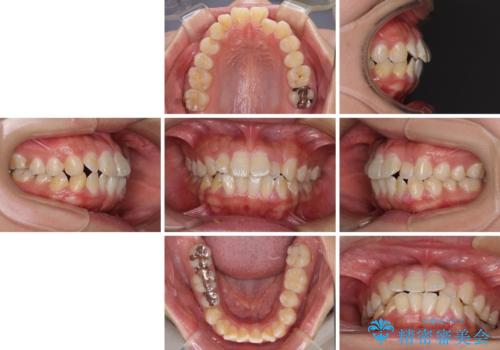 口が閉じにくい ワイヤー装置での抜歯矯正の治療前