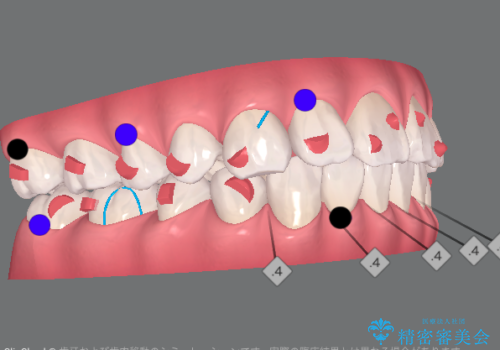 遠心移動を伴うマウスピース非抜歯矯正治療