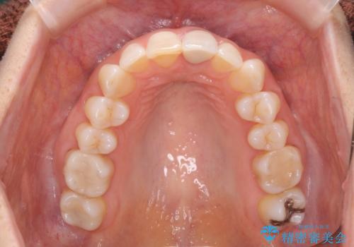 夜中の歯ぎしり ナイトガードで予防の治療前