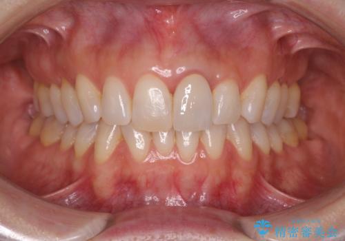 夜中の歯ぎしり ナイトガードで予防の症例 治療前