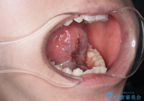 滑舌の改善　舌小帯の形成術の治療中