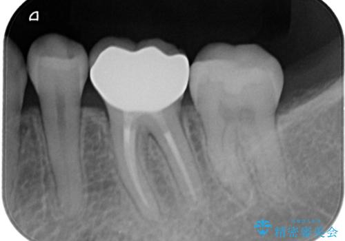 【セラミッククラウン】適合の悪いアンレーのやり替えの治療後