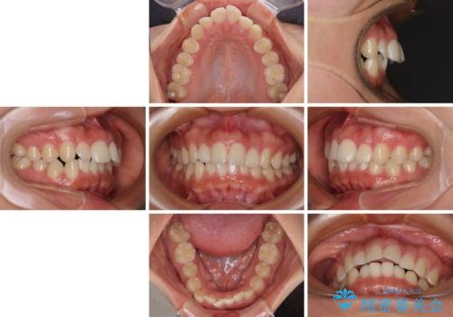 飛び出した上顎前歯 インビザラインで引っ込めるの治療前