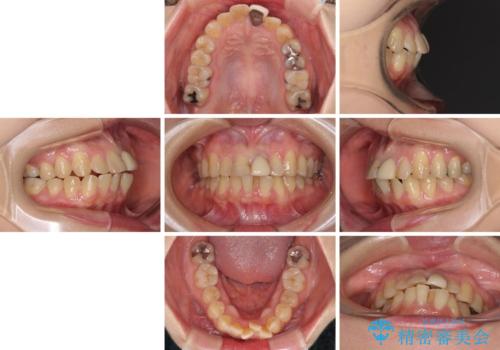 前歯のデコボコをワイヤー矯正できれいに整えるの治療前