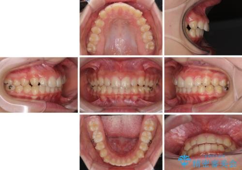 海外で始めたインビザライン 転医手続きにより治療を継続の治療前
