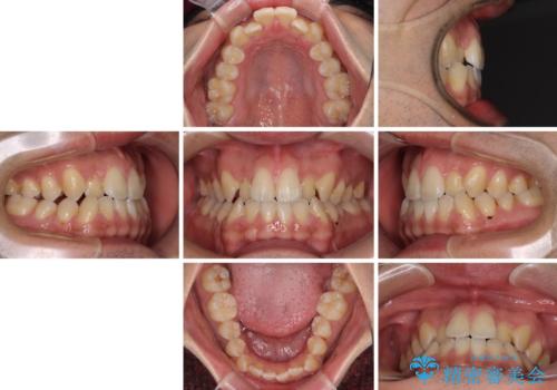 ワイヤー矯正を併用したインビザライン矯正治療の治療前