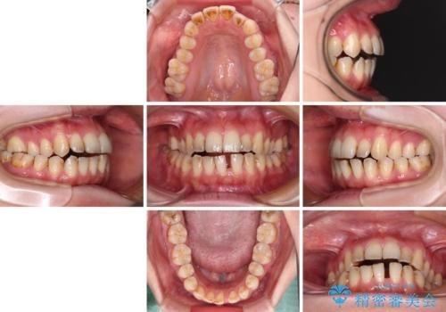 開咬と歯の欠損 ワイヤー装置を併用したインビザライン矯正治療の治療前