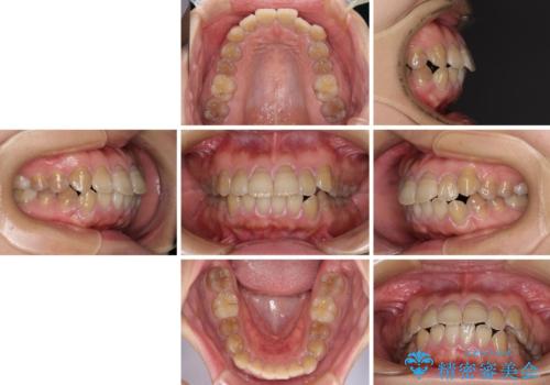横顔の印象が大きく変わる ワイヤー装置での抜歯矯正の治療前