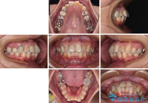 【モニター】処置歯の多い歯列　インビザラインでデコボコを整えるの治療前