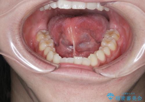滑舌の改善　舌小帯の形成術の治療前
