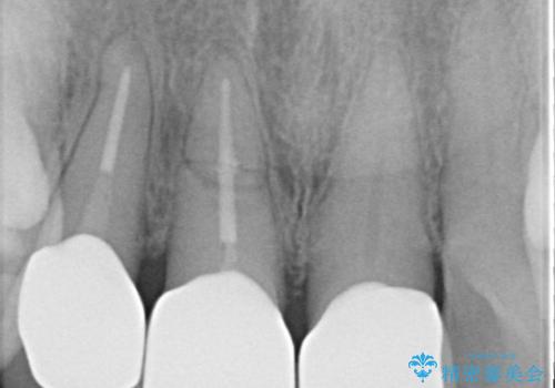 【外傷歯】根管治療から被せ物まで。の治療後
