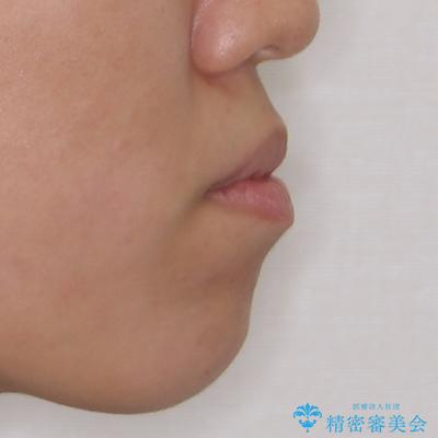 急速拡大とワイヤー抜歯矯正で唇を閉じやすくの治療前(顔貌)