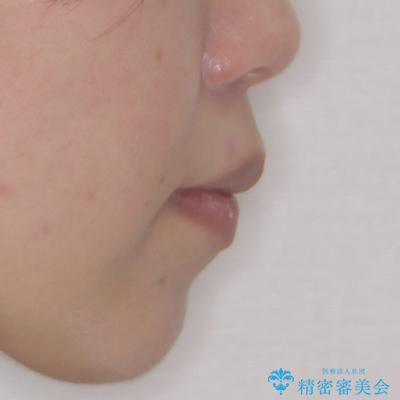 口が閉じにくい ワイヤー装置での抜歯矯正の治療前(顔貌)
