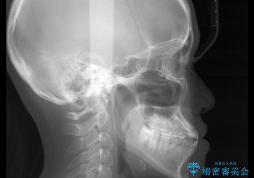 歯茎が薄い方へのインビザライン治療、歯肉退縮予防の治療前