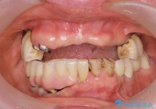 審美性に優れるノンクラスプデンチャー(バネの目立たない入れ歯)の症例 治療前