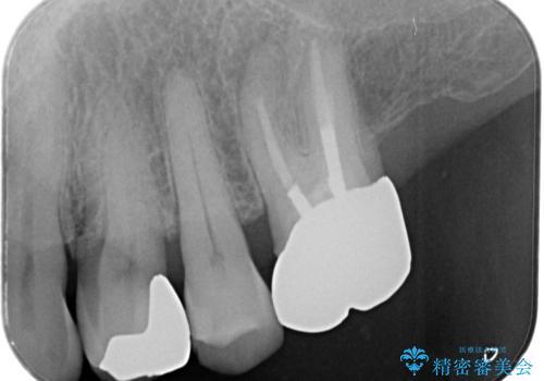 【ゴールドインレー PGA】フロスをしたら銀歯が取れたの治療後