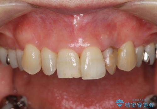 前歯の審美障害　セラミック治療の治療前