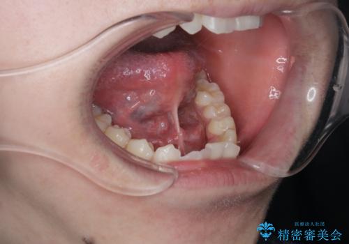 滑舌の改善　舌小帯の形成術の治療前