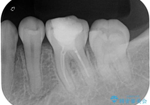 【セラミッククラウン】適合の悪いアンレーのやり替えの治療前