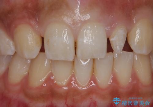 変色した前歯をキレイにしたい ジルコニアクラウンでの修復の治療中