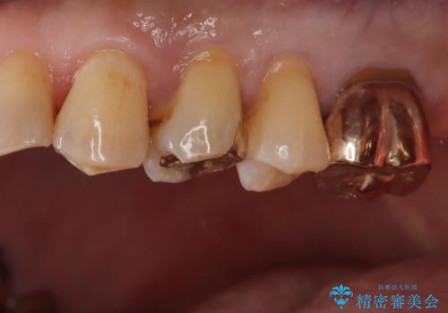 【ゴールドインレー PGA】フロスをしたら銀歯が取れたの治療後