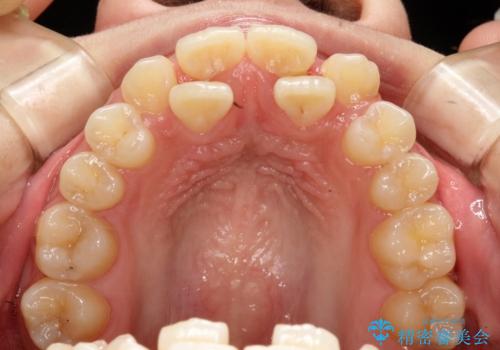 【ハーフリンガル】重度の叢生の治療前