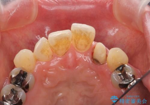 前歯の審美障害　セラミック治療の治療中
