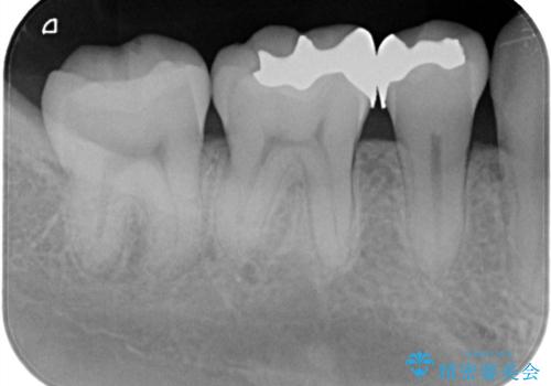 【ハイブリッドインレー】銀歯を白くしたい の治療前