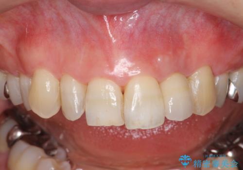 前歯の審美障害　セラミック治療の治療後