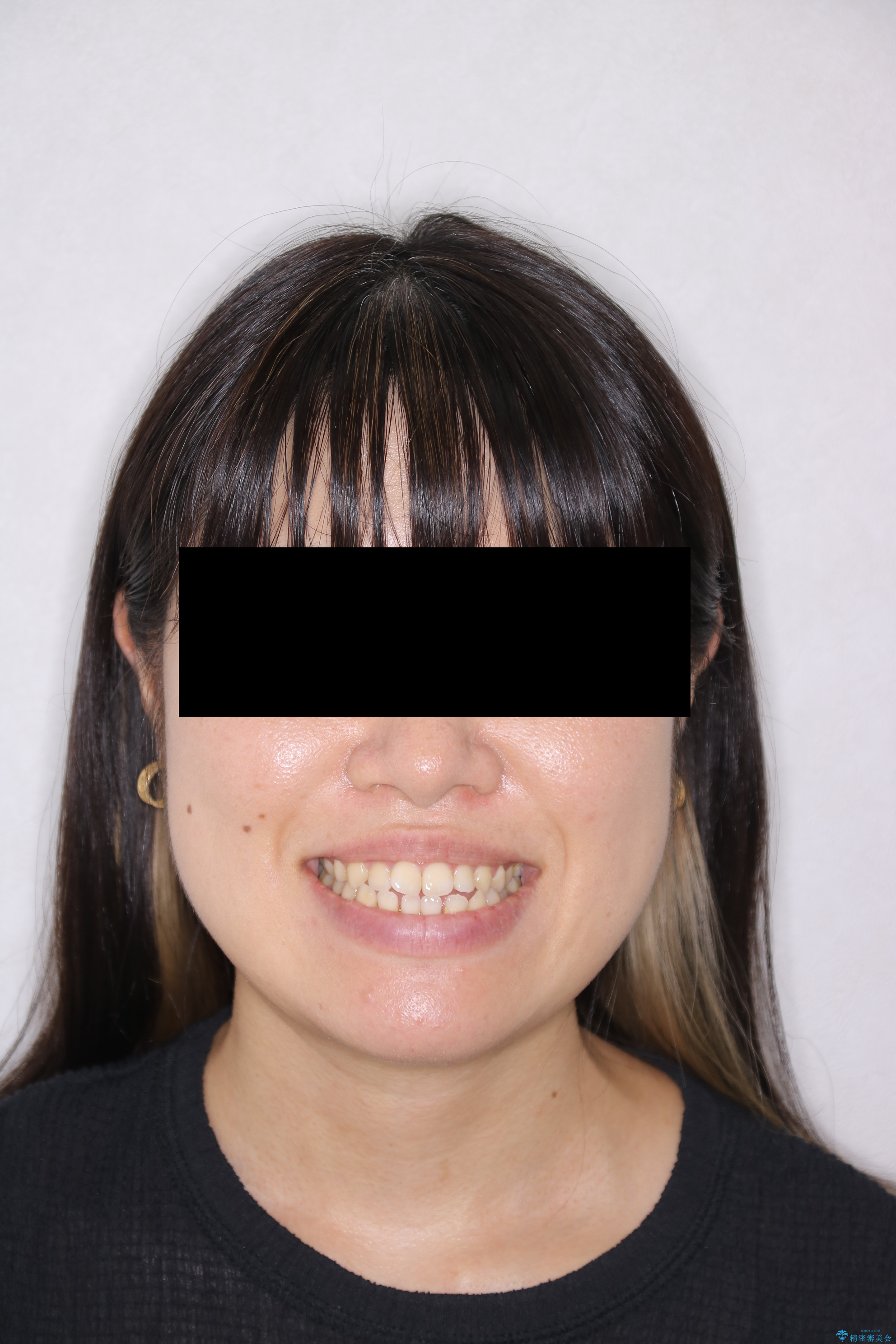 歯茎が薄い方へのインビザライン治療、歯肉退縮予防の治療前（顔貌）