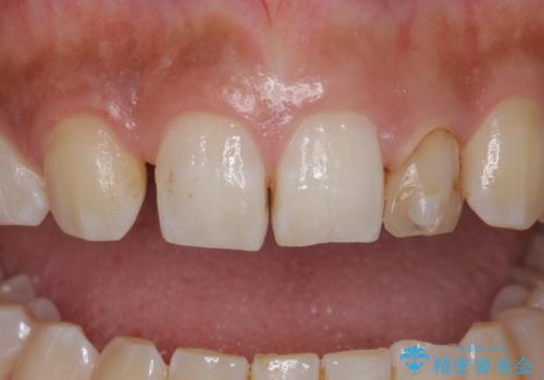 変色した前歯をキレイにしたい ジルコニアクラウンでの修復の治療前