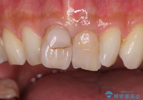 前歯をキレイにしたい ジルコニアクラウンでの治療の治療前